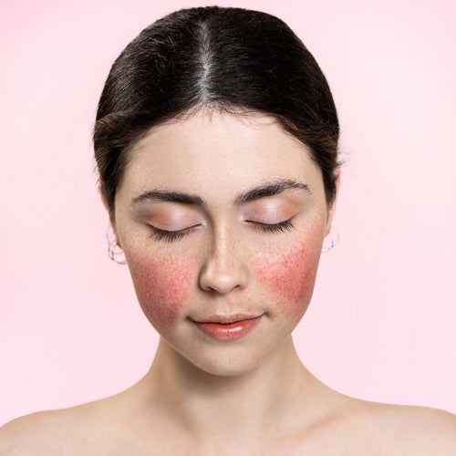What is Rosacea, and How Can I Treat it? - Harben House