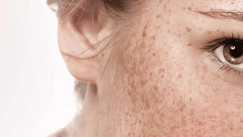 Closeup on the cheek and eye of a woman with many freckles and other pigmented spots.