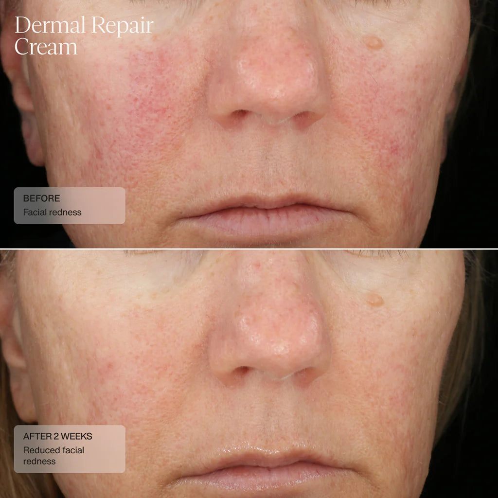 SENTÉ Dermal Repair Cream Before and After Redness after 2 weeks