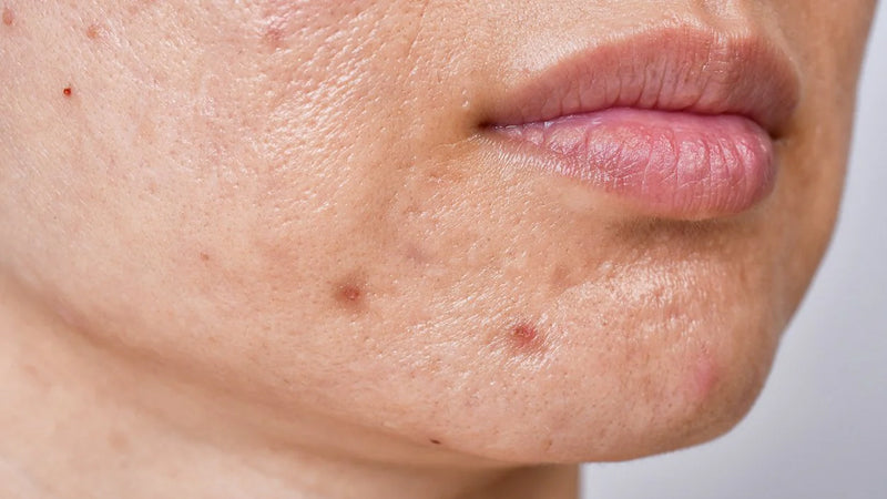 Closeup on the chin and mouth of a person with oily, blemished skin.