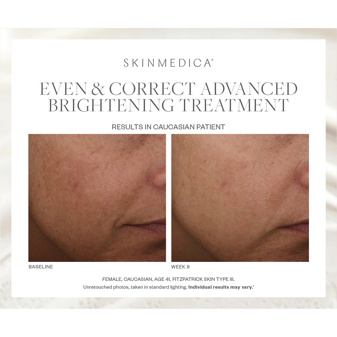 SkinMedica Even & Correct Advanced Brightening Treatment - Harben House - SkinMedica