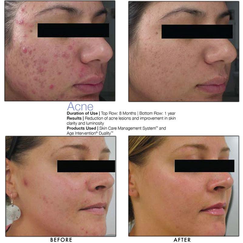 Acne Before and After