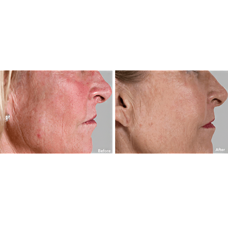 AnteAGE MD System Sun Damage Before and After