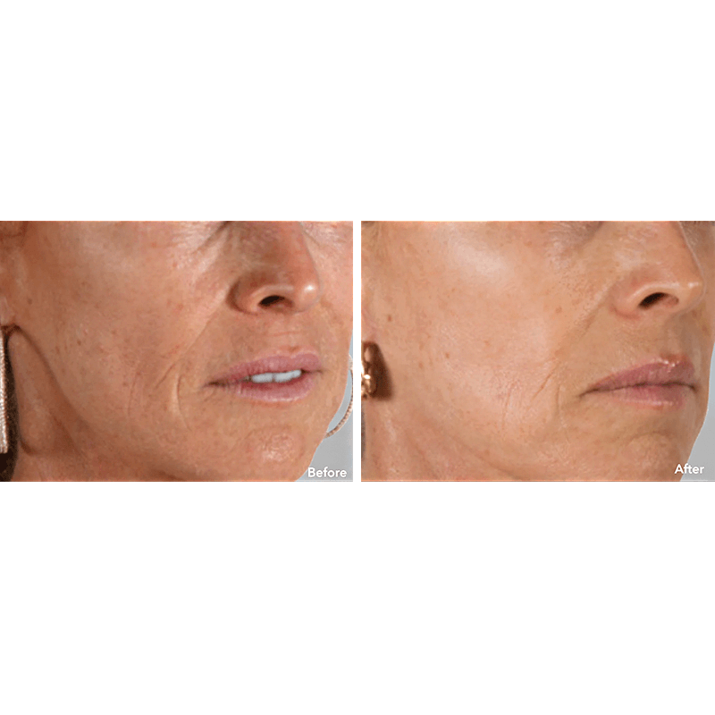 AnteAGE MD System Wrinkles Before and After