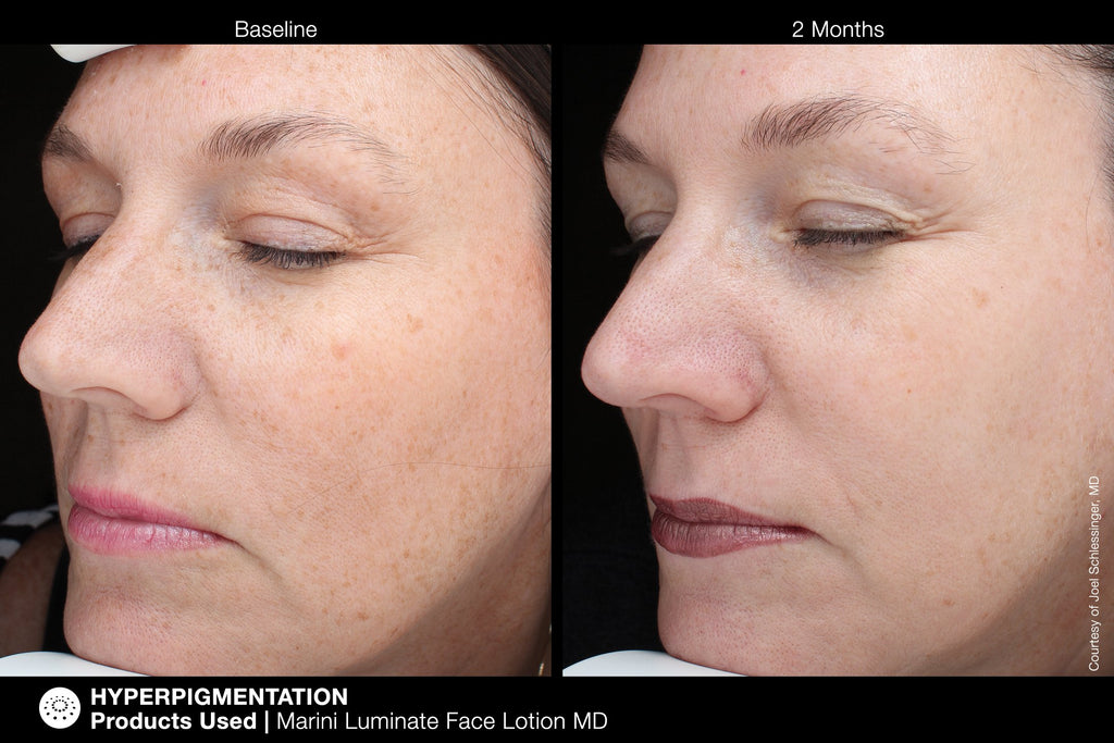 Jan Marini Marini Luminate Face Lotion - 2 month improvement before and after