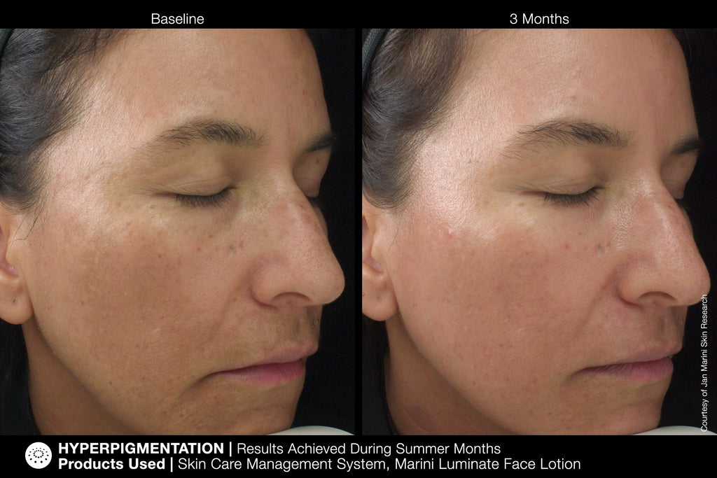 Jan Marini Marini Luminate Face Lotion - 3 month improvement before and after