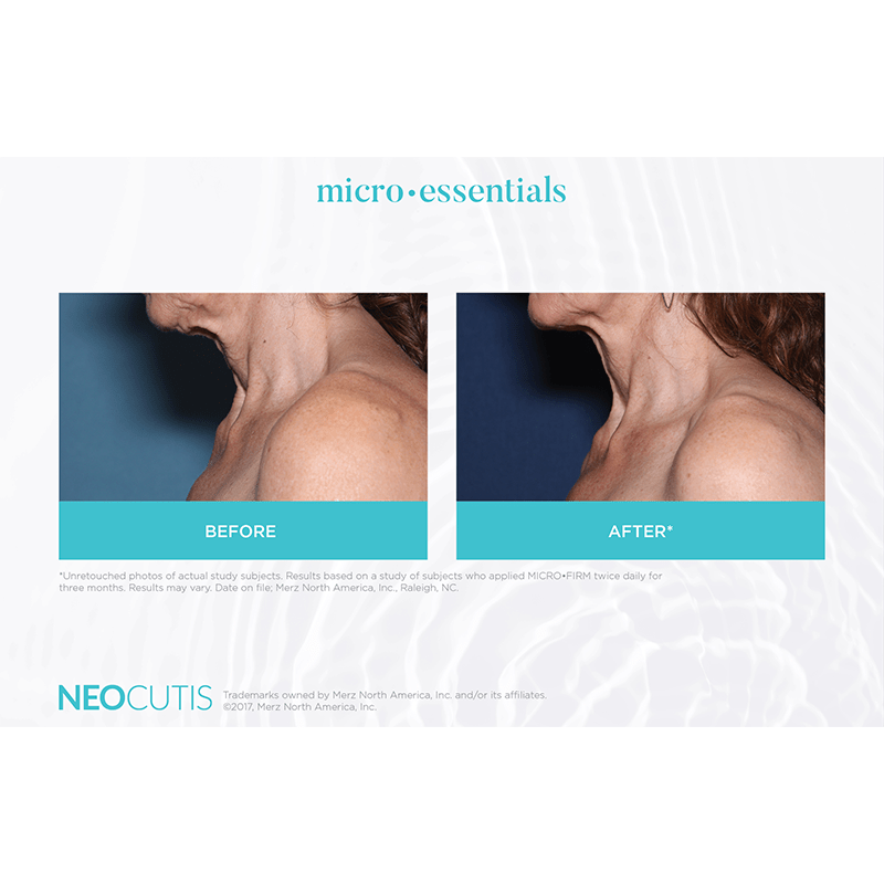 Neocutis Micro-Firm Neck and Decollete 6 Month Before and After
