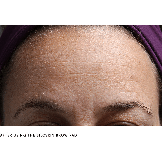 SilcSkin Brow Pads After Use - Reduction of Deep Forehead Wrinkles