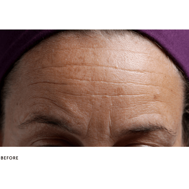 SilcSkin Brow Pads Before Use - Deep Wrinkles on Forehead