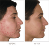 jane iredale Skin Accumax Supplements: 14 Week Reset Box Before and After Acne Imrpovement
